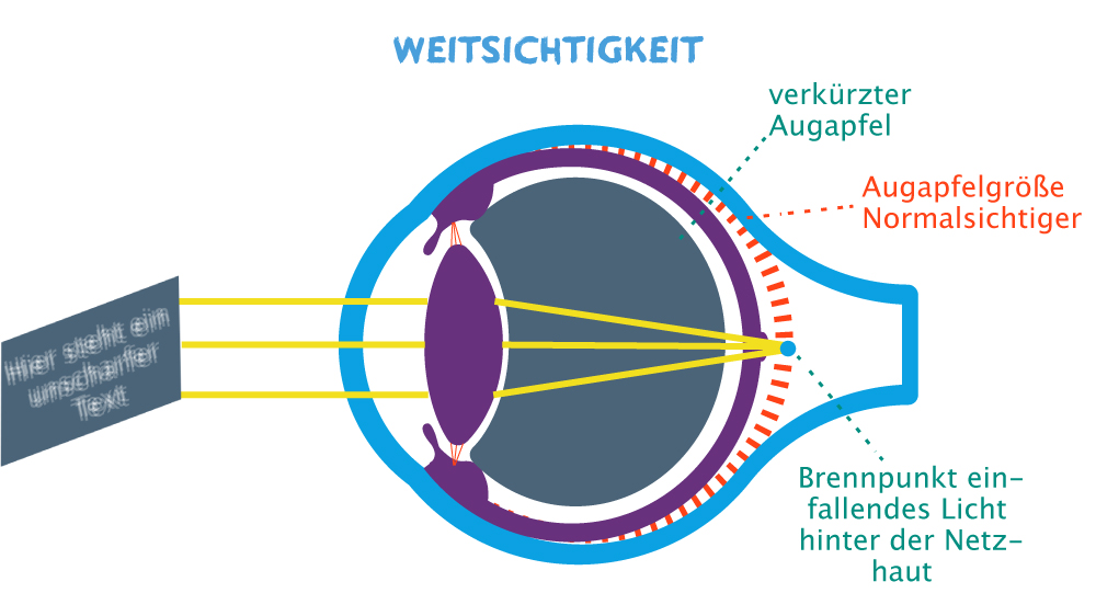 Das weitsichtige Auge: Das Licht fällt hinter dem Augapfel zusammen.