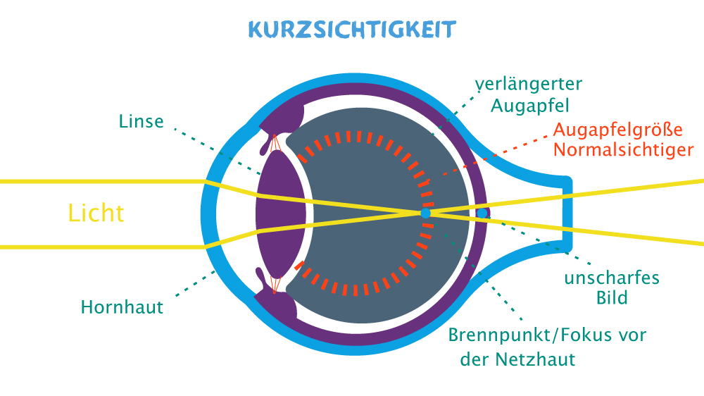 Das kurzsichtige Auge: Das Licht fällt vor der Netzhaut zusammen.